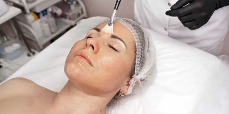 Chemical Peel Treatment in Greenville SC by Alchemy West 944x472 1